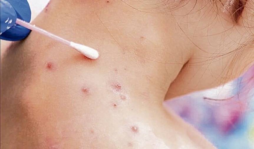 La OMS activó su máximo nivel de alerta sanitaria por la viruela del mono