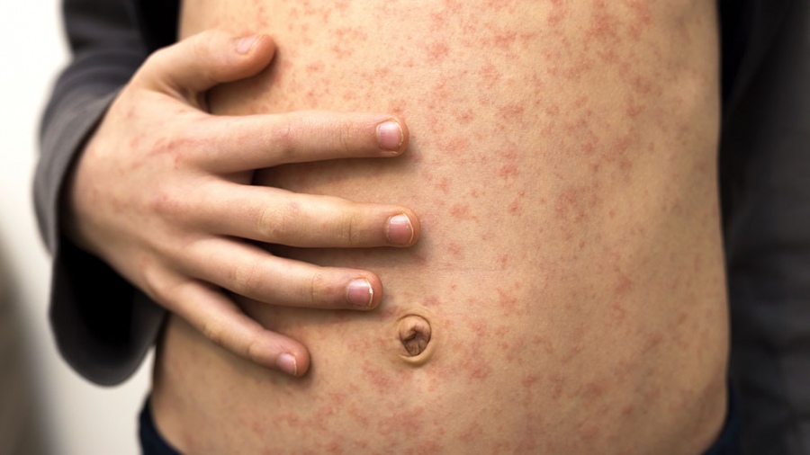 Nueva campaña: al menos 713 mil niños son susceptibles al sarampión, rubéola y paperas Nueva campaña: al menos 713 mil niños son susceptibles al sarampión, rubéola y paperas