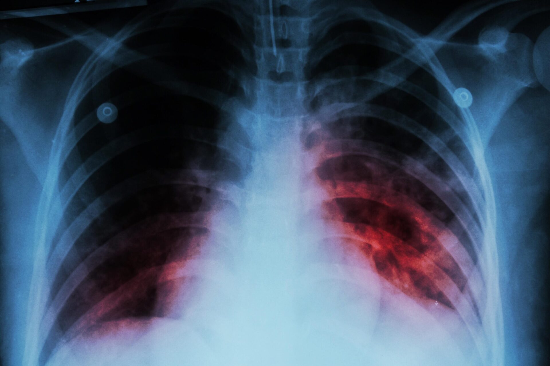 La tuberculosis regresó como principal enfermedad infecciosa mundial La tuberculosis regresó como principal enfermedad infecciosa mundial