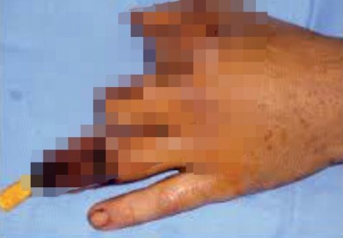 Un niño de 7 años sufrió quemaduras por pirotecnia y debieron amputarlo