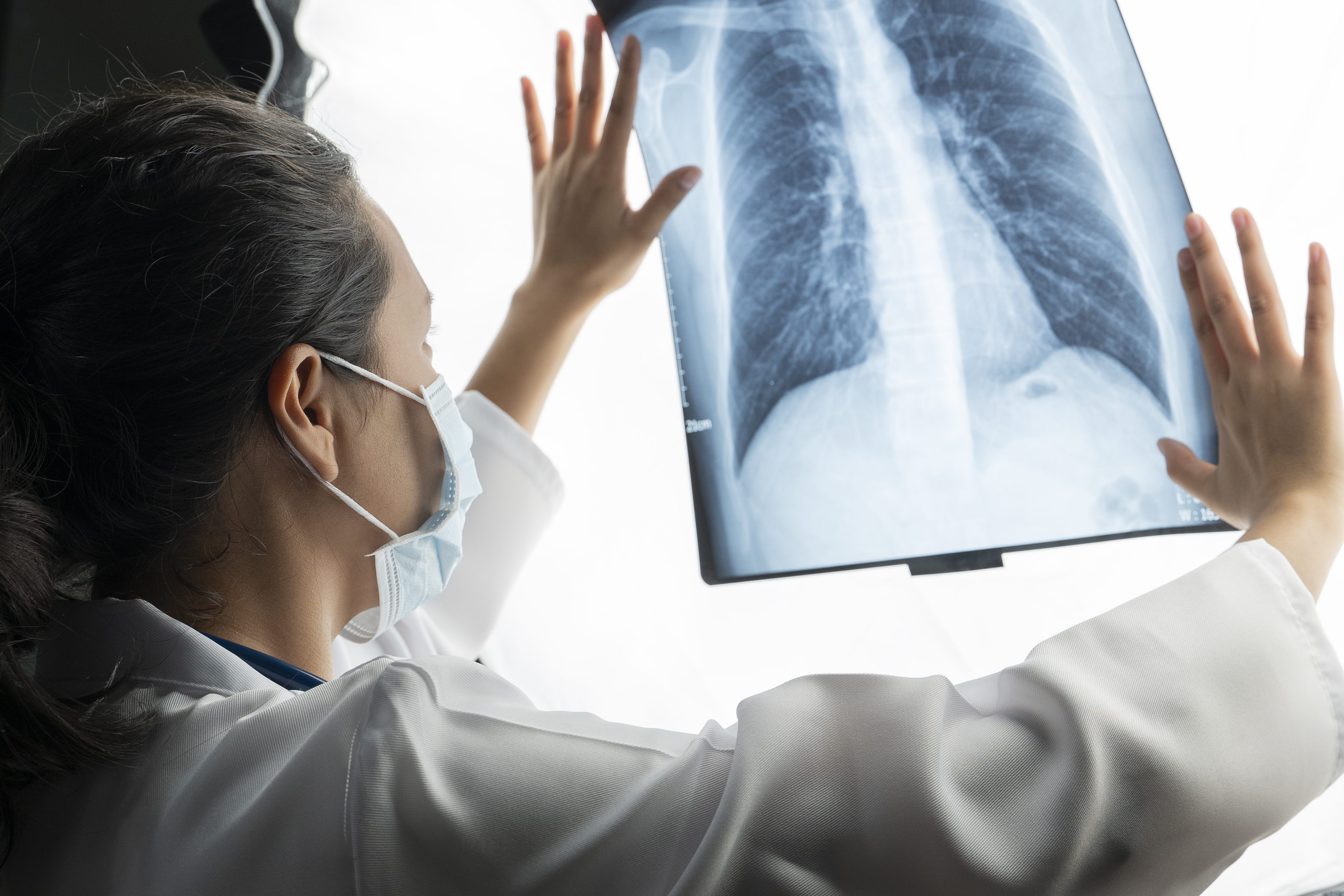 Los neumonólogos argentinos impulsan un proyecto para mejorar el diagnóstico temprano del cáncer de pulmón Los neumonólogos argentinos impulsan un proyecto para mejorar el diagnóstico temprano del cáncer de pulmón