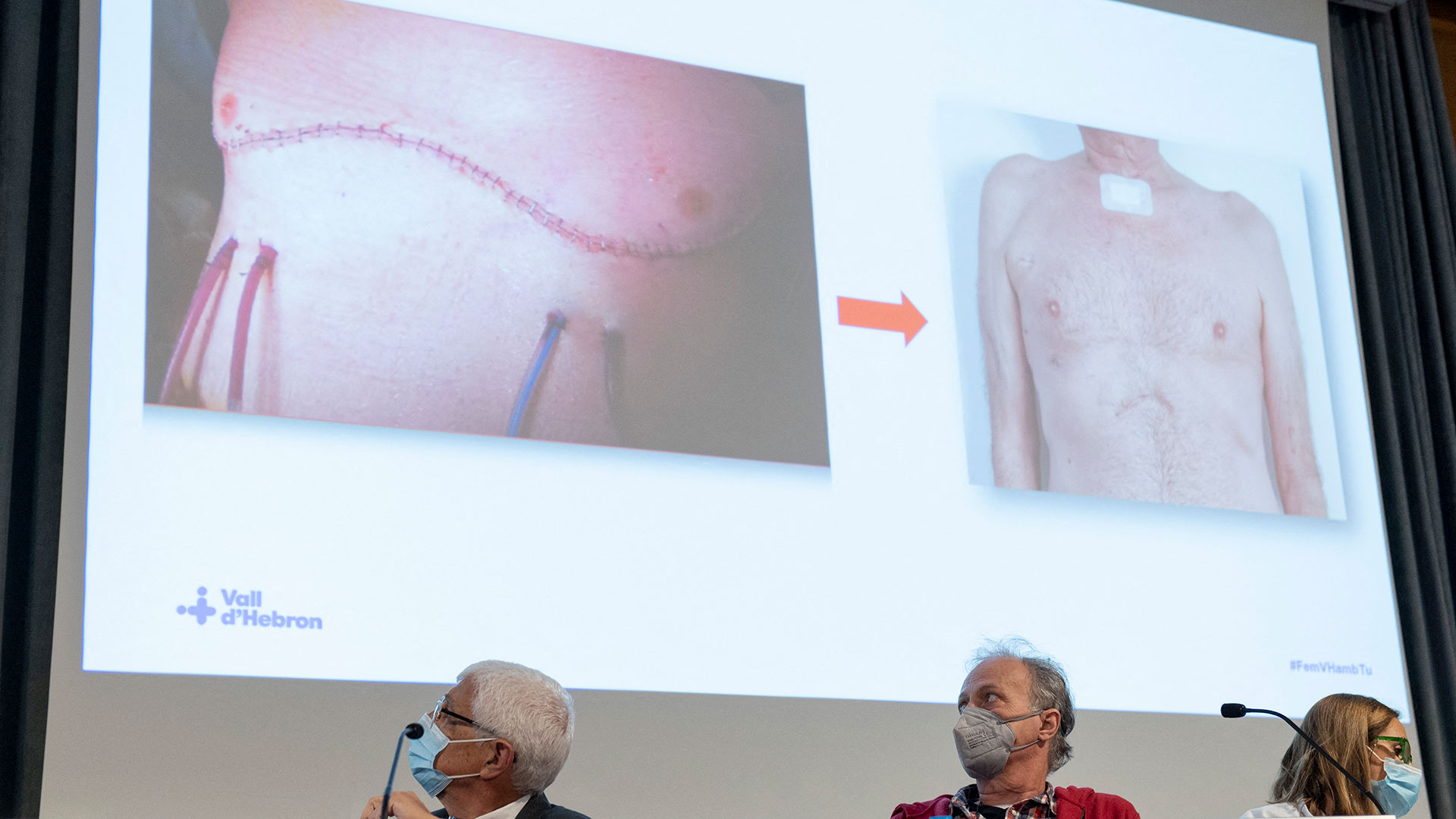 Durante un encuentro con la prensa, el jefe de Servicio de Cirugía Torácica y Trasplante Pulmonar de Vall d’Hebron, Albert Jauregui, consideró que se trata de un hito internacional de la ciencia (AFP)