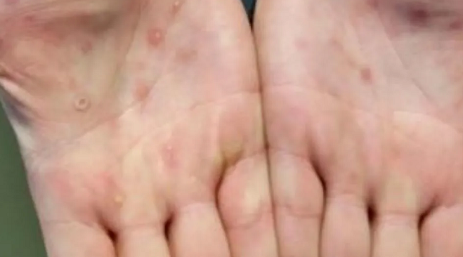 OMS: la viruela del mono ya no es una emergencia sanitaria global OMS: la viruela del mono ya no es una emergencia sanitaria global
