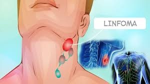 Linfoma se estima que esta enfermedad afecta a unos 9.000 argentinos. Linfoma se estima que esta enfermedad afecta a unos 9.000 argentinos.